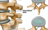 herniated disc treatment